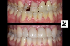 INSTAGRAM-60-ANTES-Y-DESPUES-INTRAORAL-SANTIAGO-LEON.001